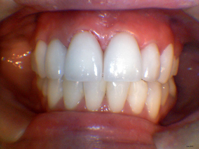 Caso Clínico - Implante Odontológico na Odontologia Moderna