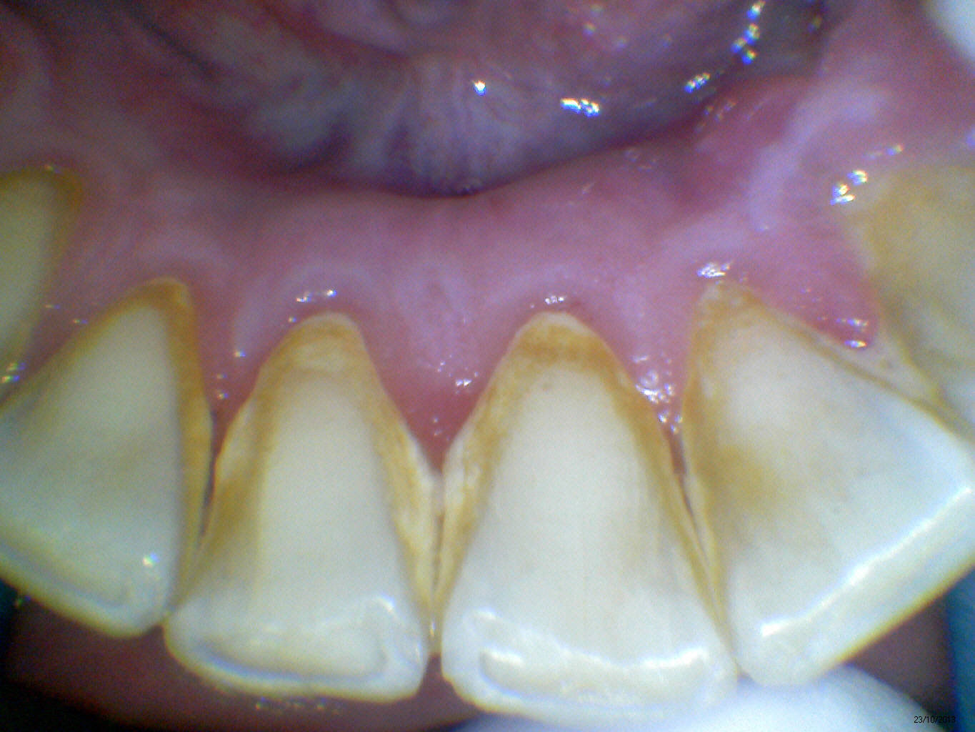 Caso Clínico - Remoção de Tártaro na Odontologia Moderna