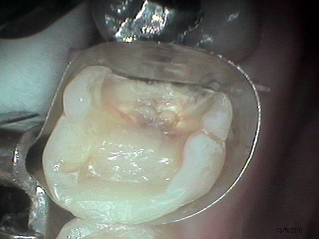 Caso Clínico - Dentística - Restauração - Estética
