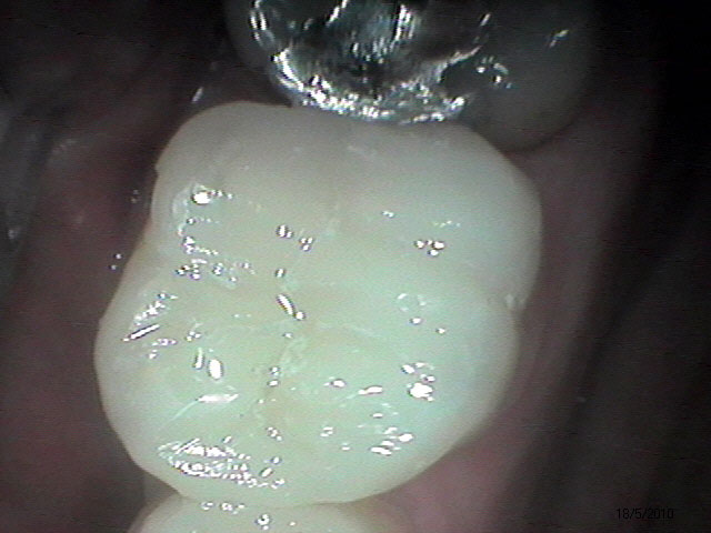 Caso Clínico - Dentística - Restauração - Estética