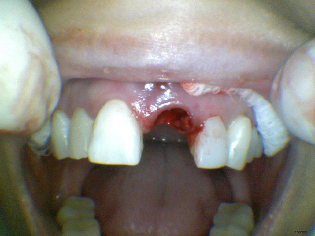 Caso Clínico - Implante Odontológico na Odontologia Moderna