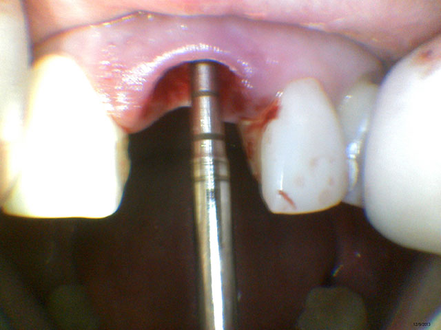 Caso Clínico - Implante Odontológico na Odontologia Moderna