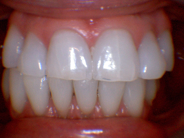 Caso Clínico - Lentes de contato dental