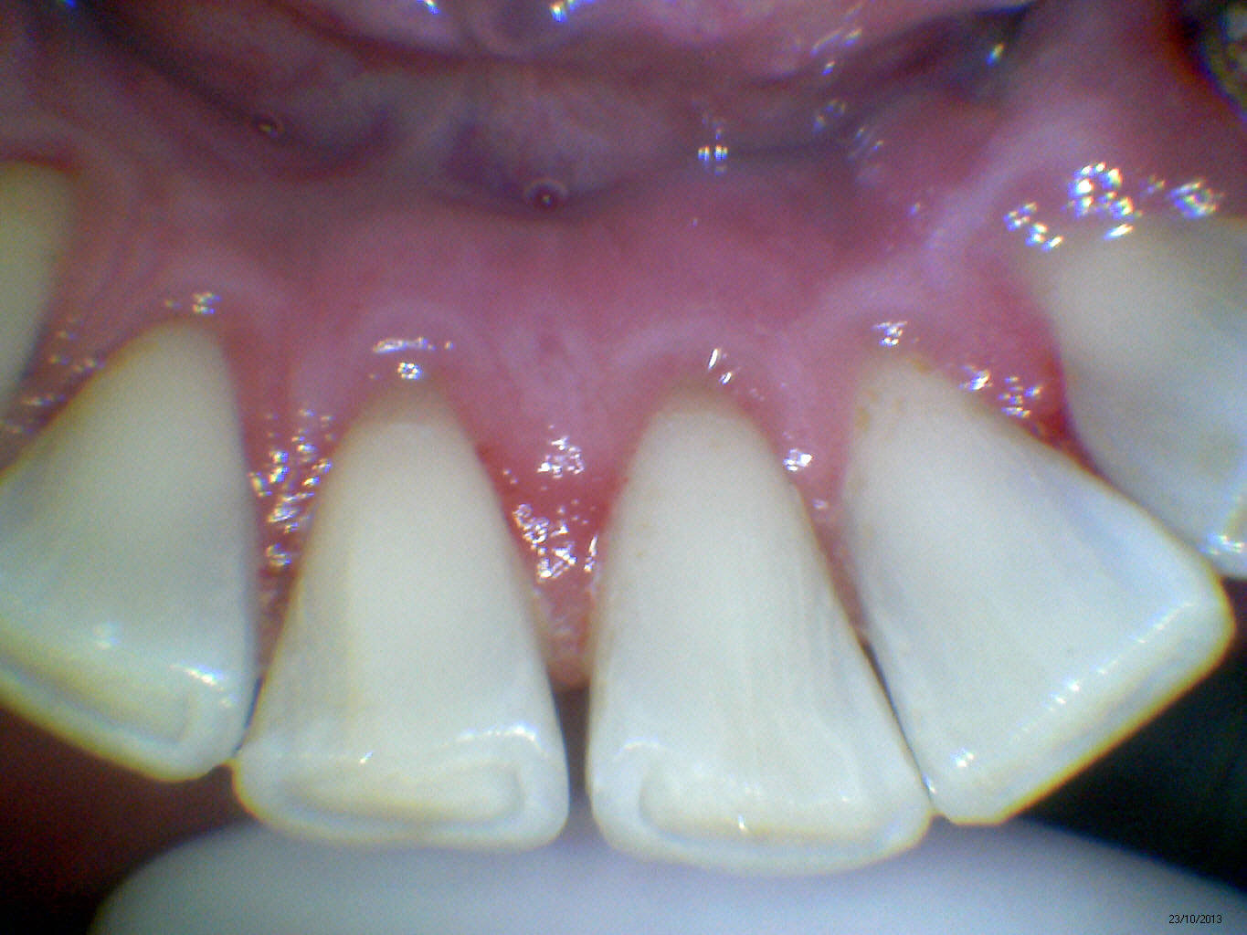 Caso Clínico - Remoção de Tártaro na Odontologia Moderna