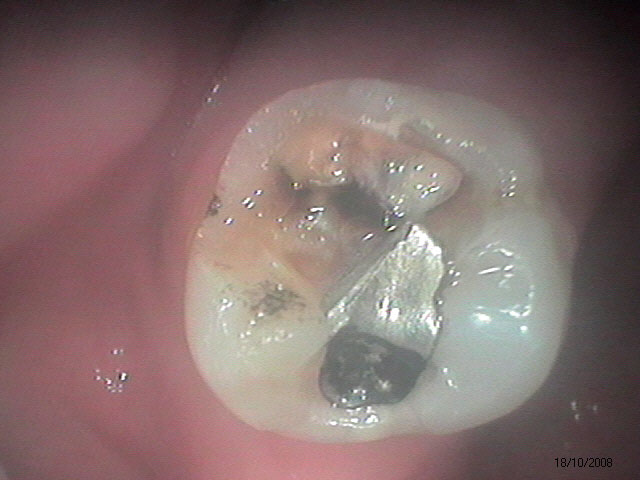 Caso Clínico - Restaurações na Odontologia Moderna