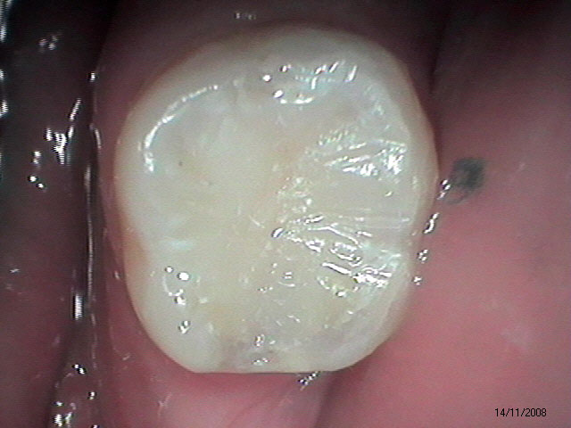 Casos Clínico - Restaurações na Odontologia Moderna