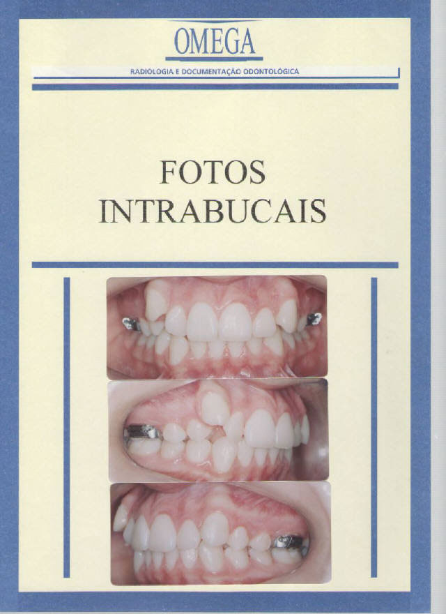 Caso Clínico - Tratamento Ortodôntico